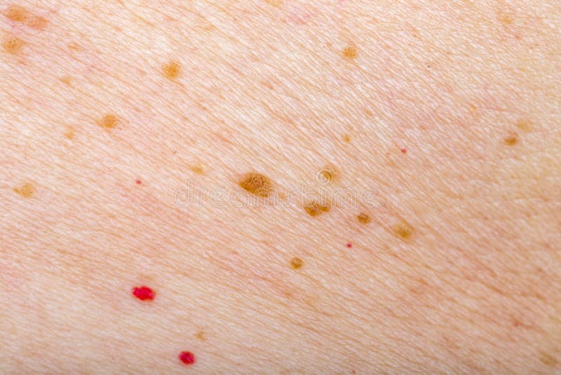 Many Nevus And Cherry Angioma On Human Skin Stock Image Image Of