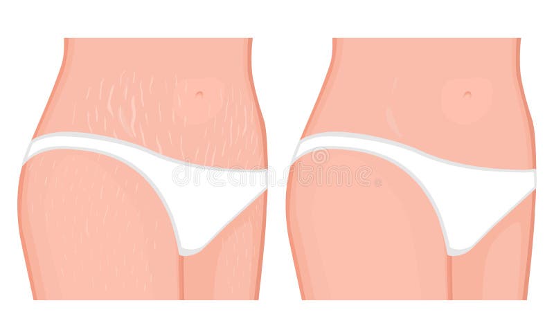 Marcas del problem_stretch del cuerpo humano en el vientre y la pierna europeos de la mujer libre illustration Marcas del problem_stretch del cuerpo humano en el vientre y la pierna europeos de la mujer libre illustration