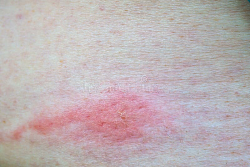 https://thumbs.dreamstime.com/b/mark-mosquito-bite-became-inflamed-allergic-reaction-appeared-mark-mosquito-bite-became-inflamed-220054616.jpg