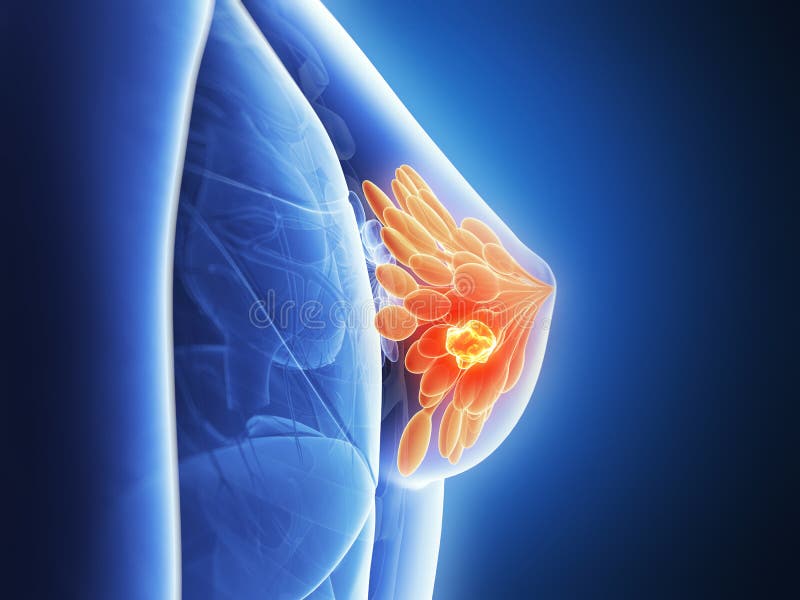 3d rendered illustration - breast cancer. 3d rendered illustration - breast cancer