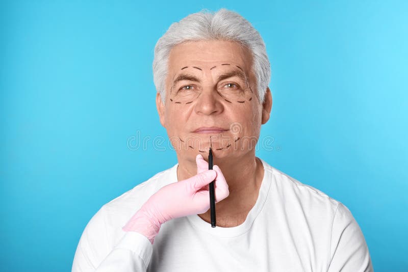 Marques de dessin de docteur sur le visage de l'homme pour l'opération de chirurgie esthétique photographie stock libre de droits Marques de dessin de docteur sur le visage de l'homme pour l'opération de chirurgie esthétique photographie stock libre de droits