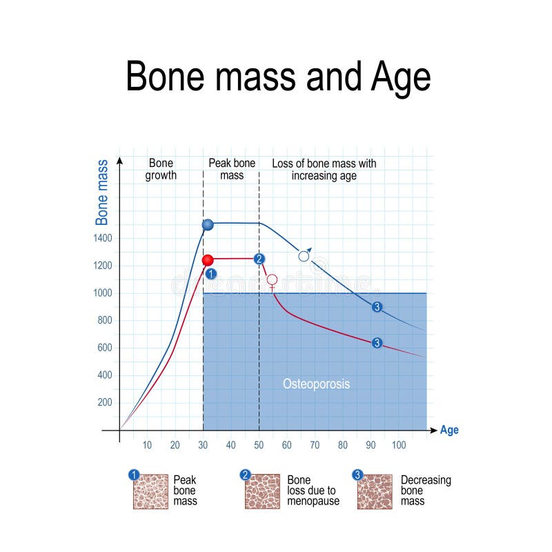 Masa del hueso para masculino y femenino Edad y osteoporosis carta