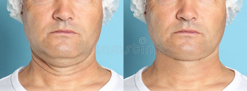 Mature Man Before And After Plastic Surgery Operation On Background