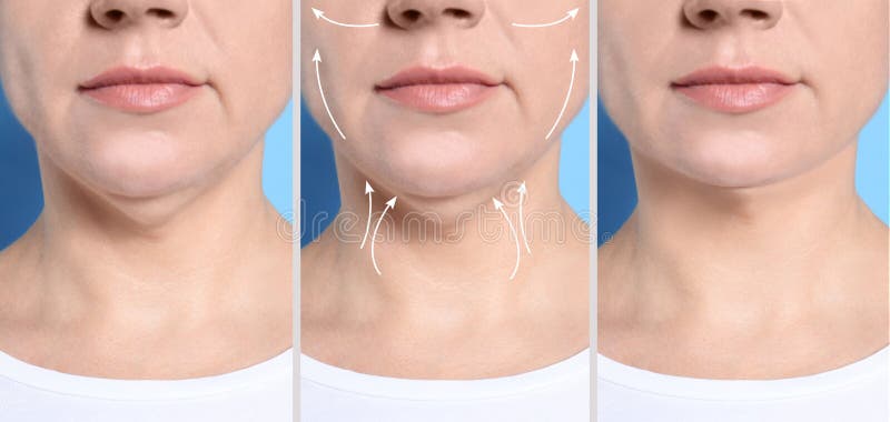 Mature woman before and after plastic surgery operation on blue background. Double chin problem stock image Mature woman before and after plastic surgery operation on blue background. Double chin problem stock image