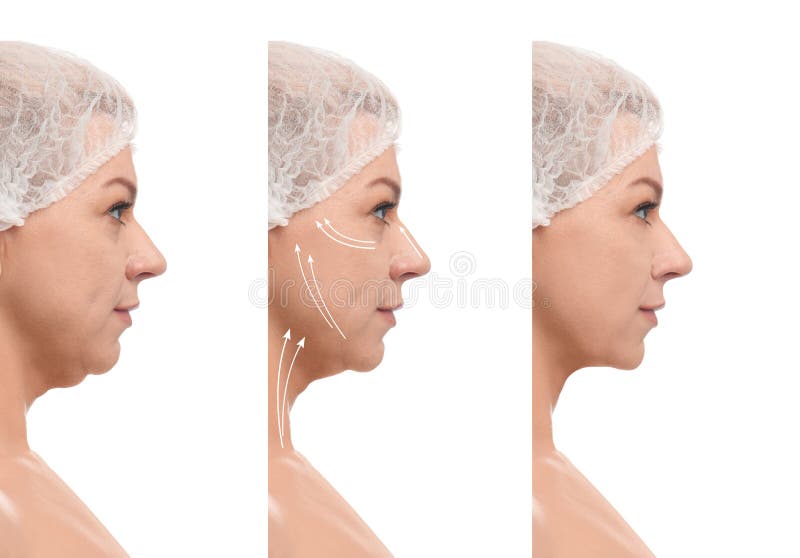 Mature woman before and after plastic surgery on white background. Double chin problem royalty free stock images