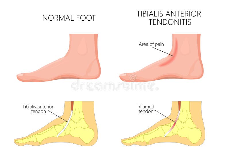 Medial kostek injury_Tibialis anterior tendonitis ilustracji Medial kostek injury_Tibialis anterior tendonitis ilustracji