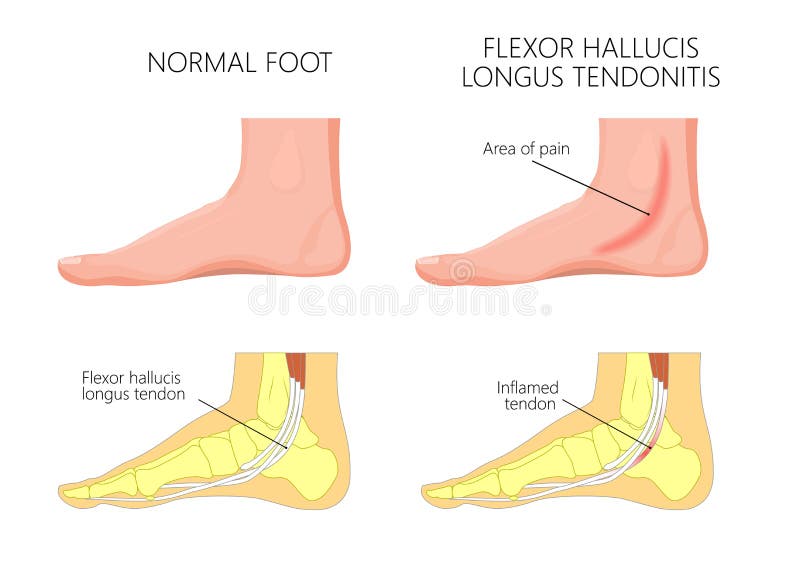 Medial kostki injury_Flexor hallucis tendonitis ilustracja wektor Medial kostki injury_Flexor hallucis tendonitis ilustracja wektor