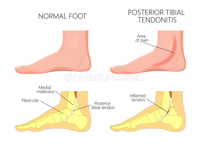 Medial kostki injury_Posterior goleniowy tendonitis ilustracja wektor Medial kostki injury_Posterior goleniowy tendonitis ilustracja wektor