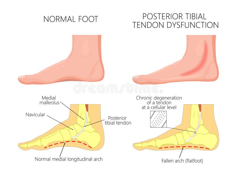 Medial kostki injury_Posterior goleniowy ścięgnowy dysfunkcja ilustracja wektor Medial kostki injury_Posterior goleniowy ścięgnowy dysfunkcja ilustracja wektor