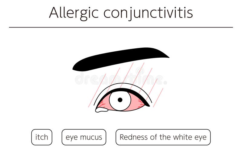 Medical Clipart, Line Drawing Illustration of Eye Disease and Allergic ...