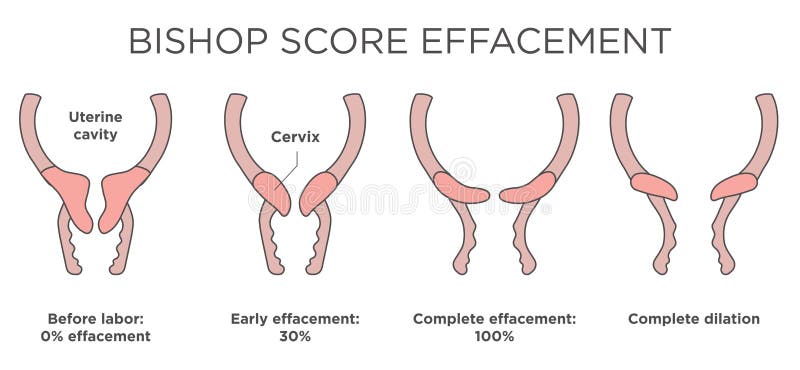 Effacement Chart