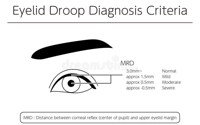 Medical Illustration Diagram of Severe Ptosis (eyelid Drooping Stock