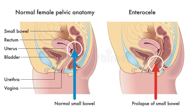 Médico ilustraciones muestra una mujer pélvico, uno pequeno intestino, opuesto uno ruptura de pequeno intestino la llamada.