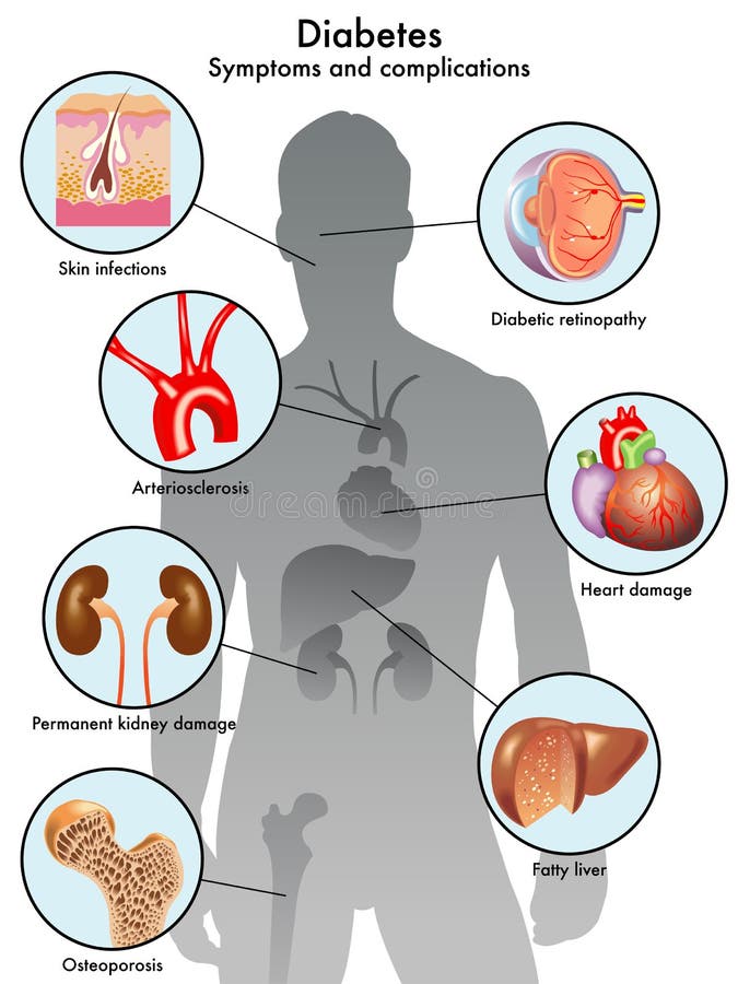 acid reflux symptoms