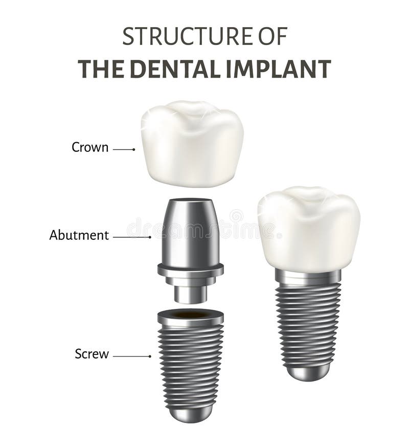Medical poster showing a structure of the dental implant. Vector illustration isolated on the white background. stock illustration Medical poster showing a structure of the dental implant. Vector illustration isolated on the white background. stock illustration