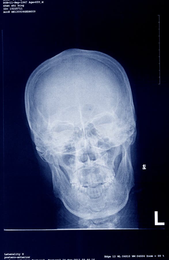 Xray/Face side stock image. Image of health, disease, diagnosis 198831