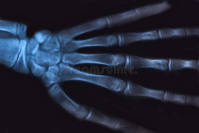 Medical x-ray image of human hand. Radiology diagnostic of skeleton bones royalty free stock photos Medical x-ray image of human hand. Radiology diagnostic of skeleton bones royalty free stock photos