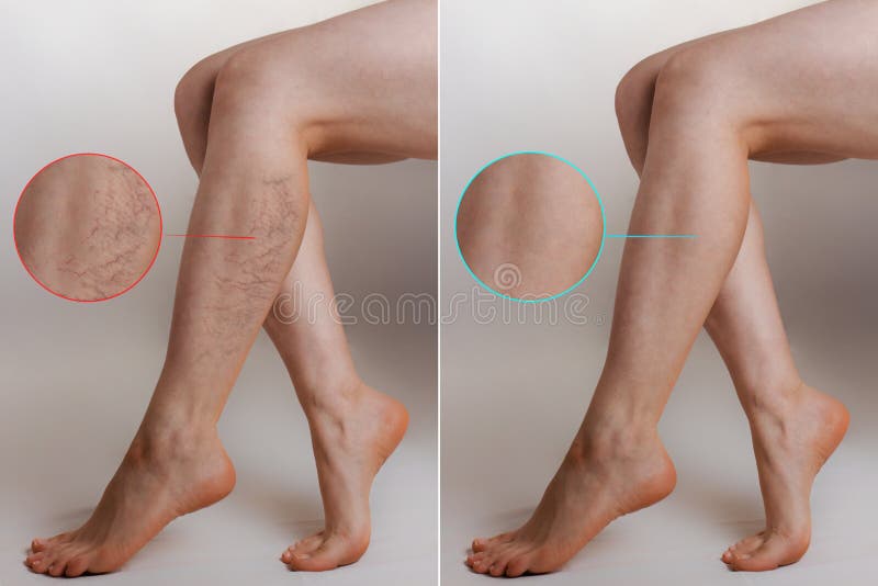 Medicina e salute Concetto di vene varicose femminili Cosce femmine con stelle vascolari sulle gambe, con un'immagine ingrandita