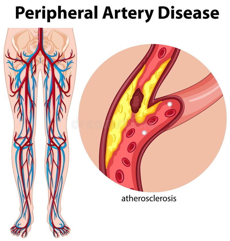 Medische perifere arteriële aandoening