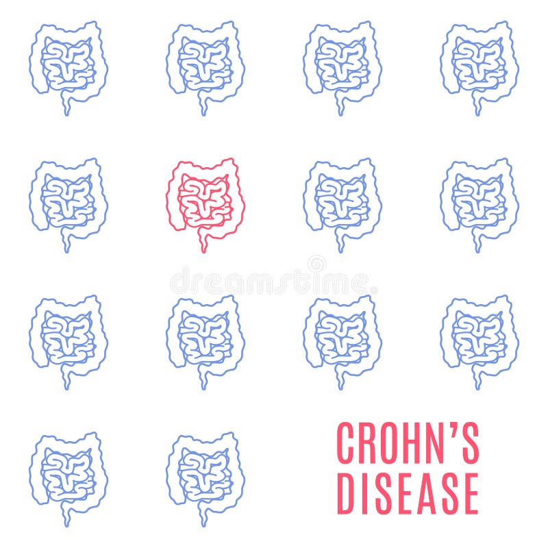 Medizinisches Plakat des linearen Musters Crohns-Krankheit vektor abbildung Medizinisches Plakat des linearen Musters Crohns-Krankheit vektor abbildung