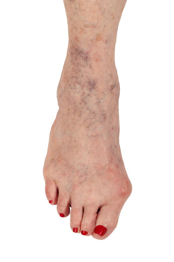 Female senior citizen right foot showing three medical conditions: 1) Bunion (hallux valgus) a deformity of lateral deviation of the big toe (metatarsophalangeal joint) 2) Hammer toe or contracted toe, a deformity of the proximal interphalangeal joint of the second, third, or fourth toe causing it to be permanently bent. 3) Varicose veins. Female senior citizen right foot showing three medical conditions: 1) Bunion (hallux valgus) a deformity of lateral deviation of the big toe (metatarsophalangeal joint) 2) Hammer toe or contracted toe, a deformity of the proximal interphalangeal joint of the second, third, or fourth toe causing it to be permanently bent. 3) Varicose veins