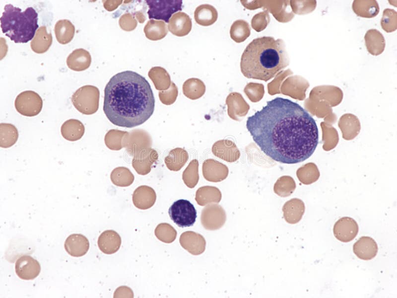 Megaloblastic Anemia, Bone Marrow. Stock Photo - Image of medical