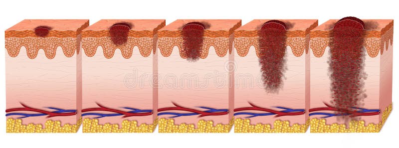 Various stages of degeneration of melanoma