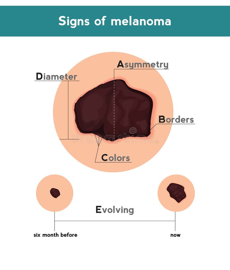 Melanoma ABCDE signs. Vector illustration of skin patch with skin cancer royalty free illustration Melanoma ABCDE signs. Vector illustration of skin patch with skin cancer royalty free illustration