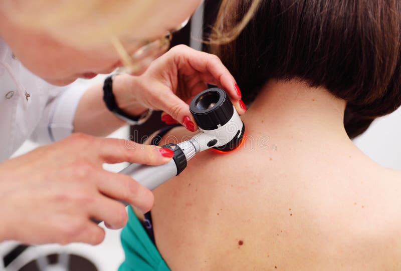 Melanoma diagnoinspectionsis. the doctor examines the patient`s mole