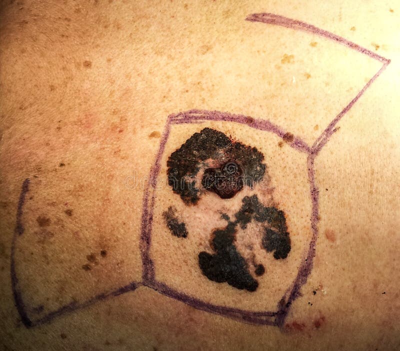 542 Sun Melanoma Stock Photos Free & RoyaltyFree Stock Photos from