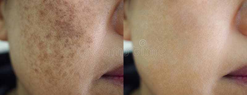 Obraz před a po místo pigmentace obličejový léčba na asijský žena.