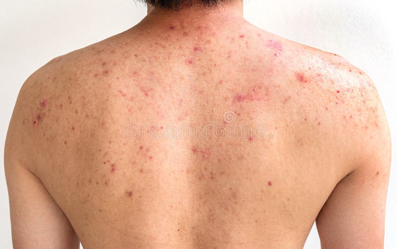 Men with acne, with red spots on the back