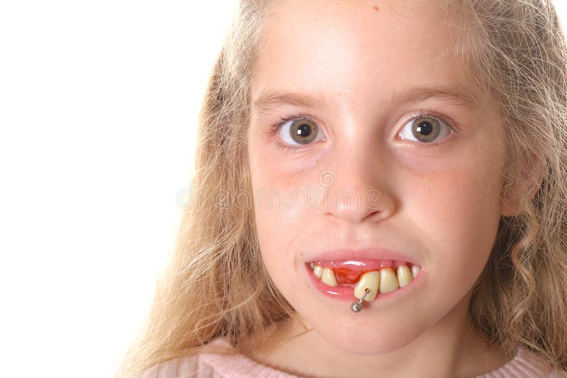 Featured image of post The Best 22 Fotos De Dente Podre Infantil