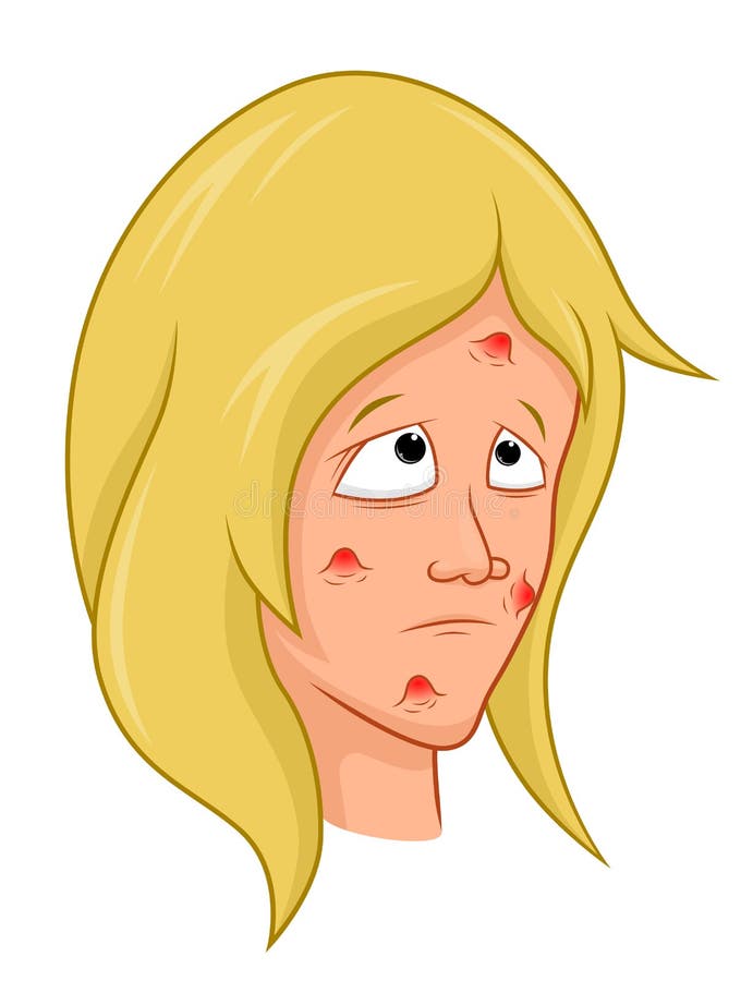 Menina dos desenhos animados com acne ilustração royalty free Menina dos desenhos animados com acne ilustração royalty free