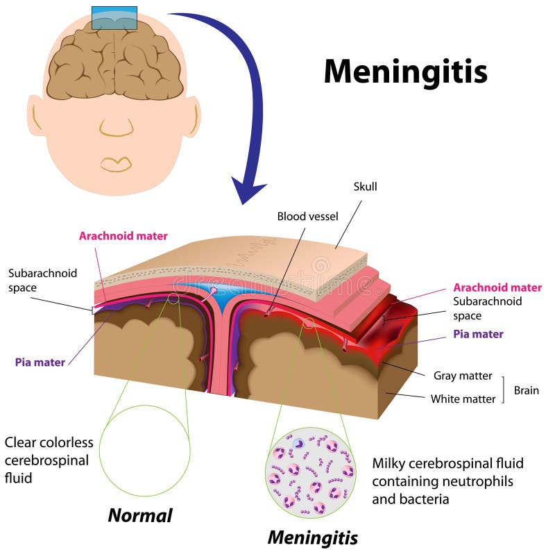 Meningite ilustração stock
