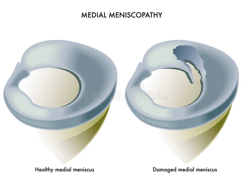 Meniscopathy mediale