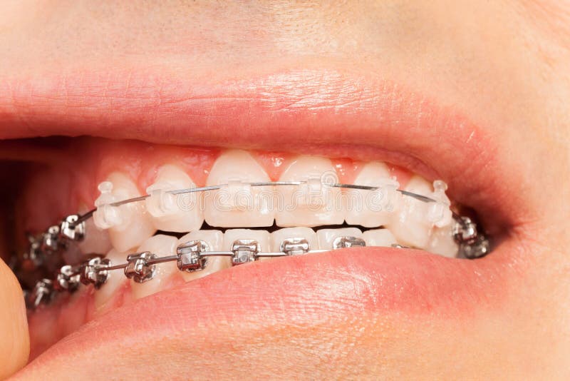 Mens die orthodontie en beetcorrectie tonen stock foto's Mens die orthodontie en beetcorrectie tonen stock foto's