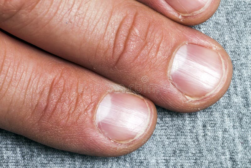 Close Up Bitten Nails Stock Photos - Free & Royalty-Free Stock Photos from  Dreamstime