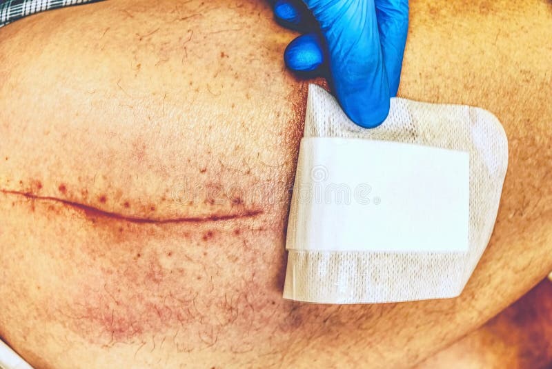 Menselijk been met postoperatief litteken van gezamenlijke chirurgie Detail van huid stock fotografie Menselijk been met postoperatief litteken van gezamenlijke chirurgie Detail van huid stock fotografie