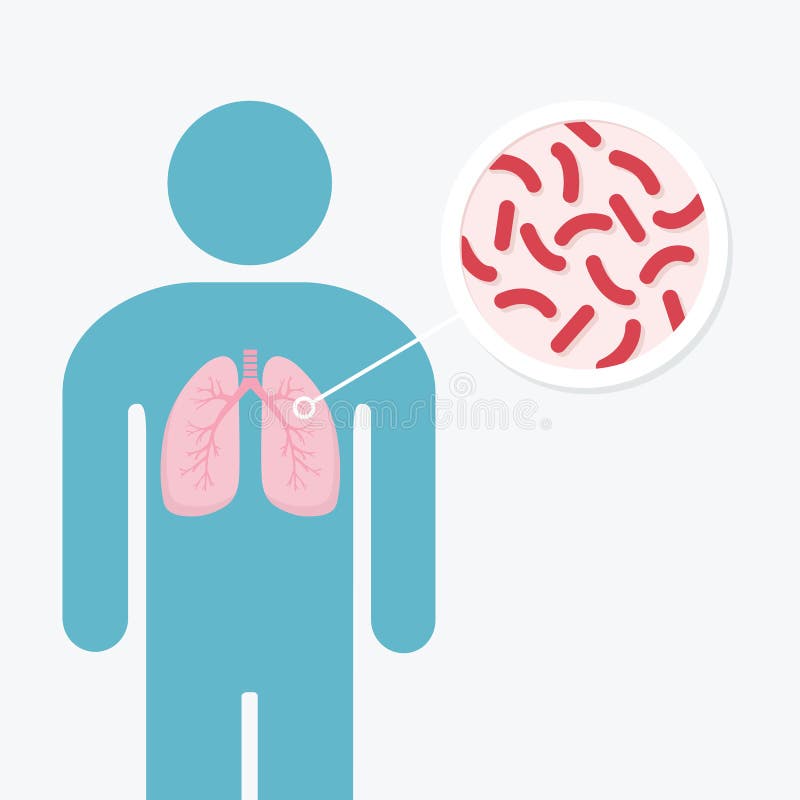 Menselijk de anatomiediagram van de longziekte Longen van besmette persoon Het gevaar van tuberculosebacteriën vector illustratie Menselijk de anatomiediagram van de longziekte Longen van besmette persoon Het gevaar van tuberculosebacteriën vector illustratie