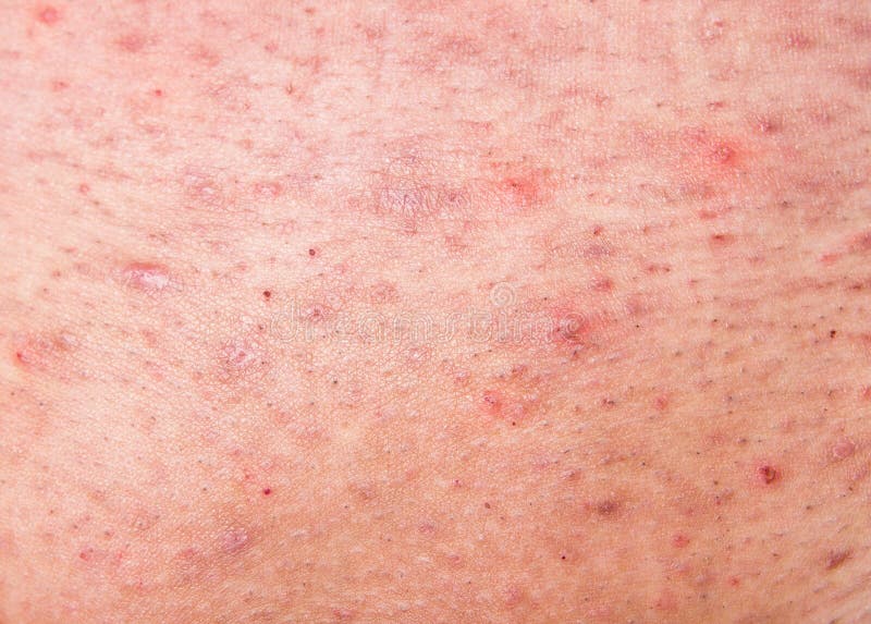 terwijl plus theater Menselijke huid met acne stock foto. Image of rood, plaag - 28330198