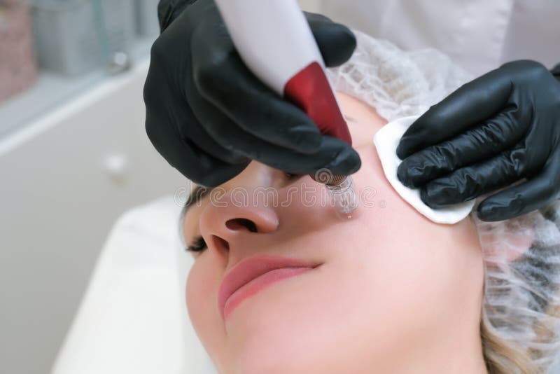 Mesoterapia con aguja. el cosmetólogo realiza la mesoterapia de aguja en la cara de la mujer