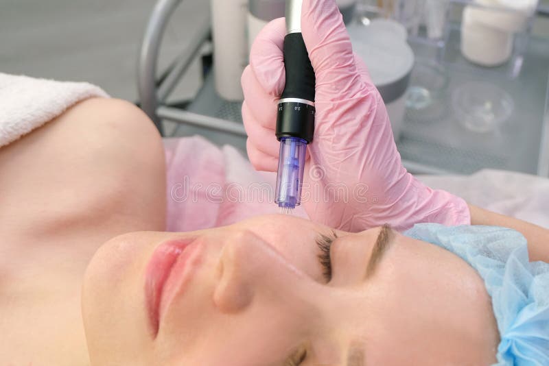 Mesoterapia con aguja. el cosmetólogo realiza la mesoterapia de aguja en la cara de la mujer