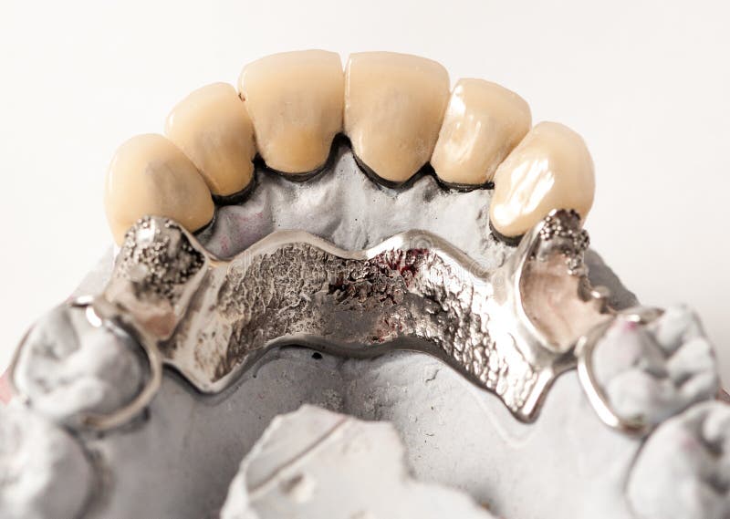 Metal Ceramic Bridge stock photo. Image of procedure 67202946