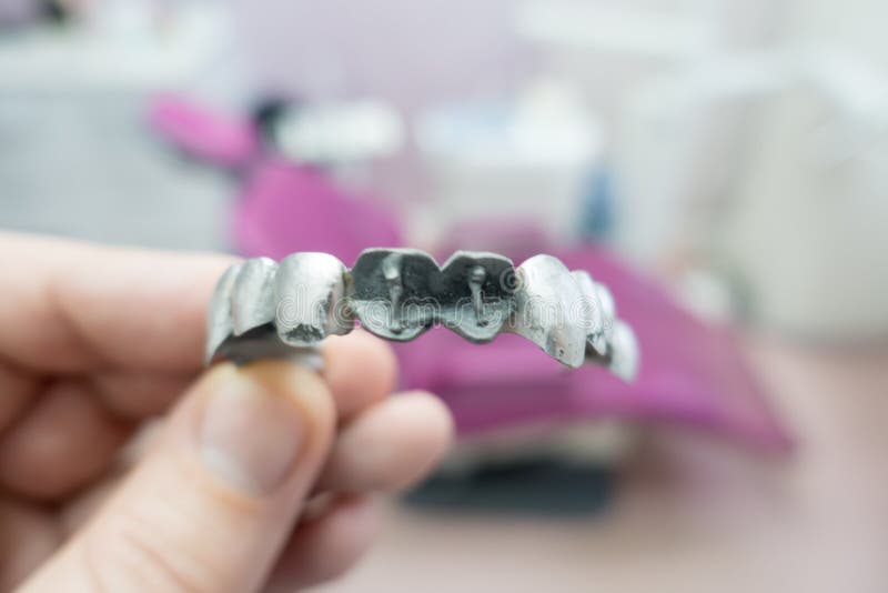 Metal dental bridge stock image. Image of cast, bite 182021719