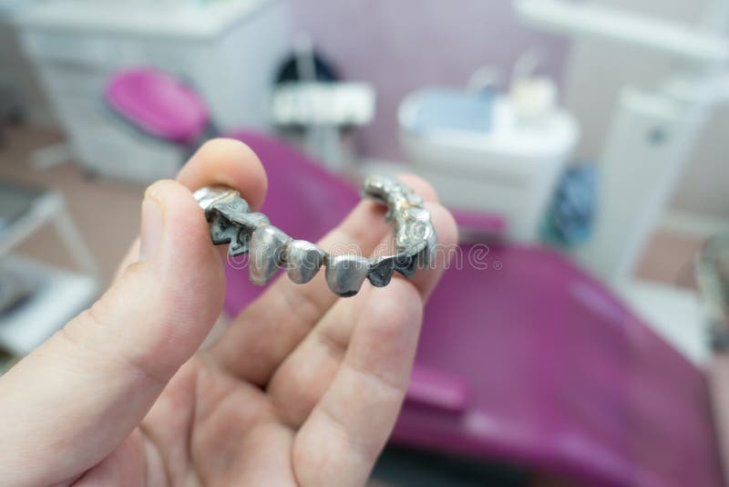 Metal dental bridge stock photo. Image of dentist, cast 236666528