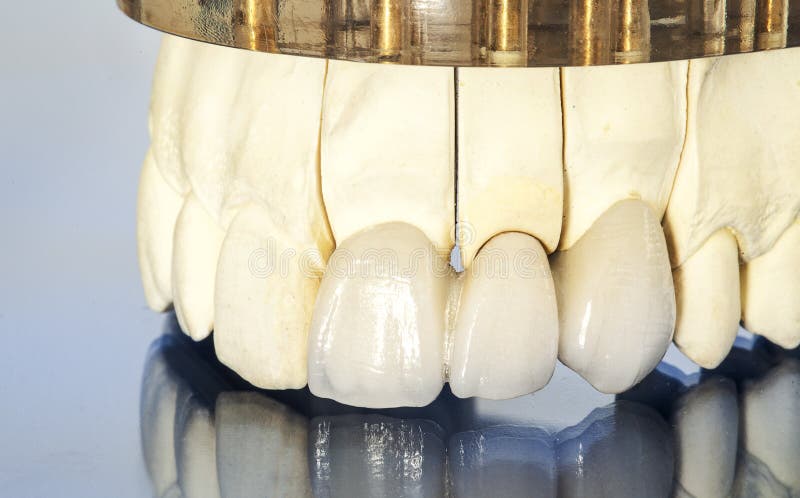Metal free ceramic dental crowns stock image Metal free ceramic dental crowns stock image