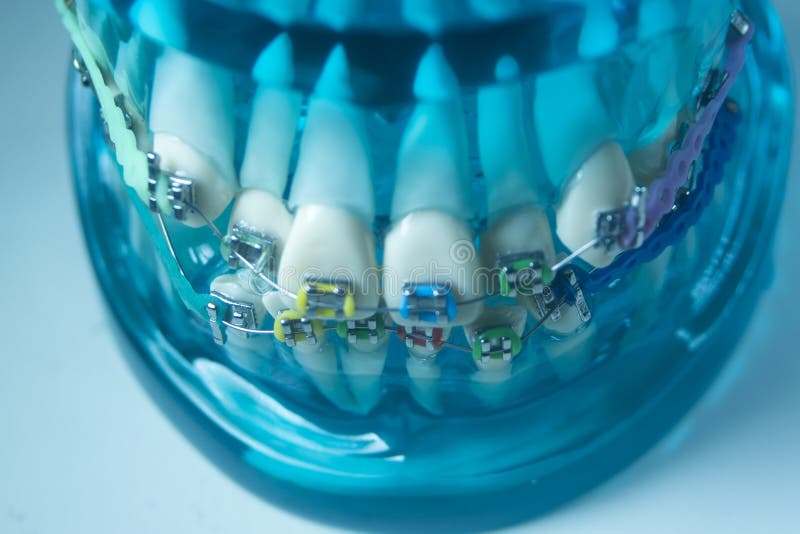 Metal teeth brackets stock photo. Image of dental, modern 214828560