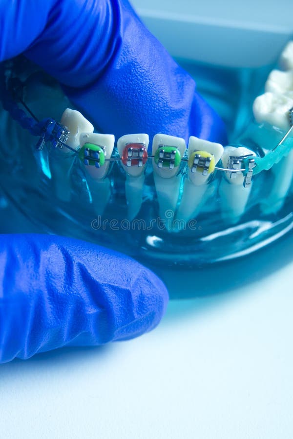 Metal teeth brackets stock photo. Image of care, beauty 214828564