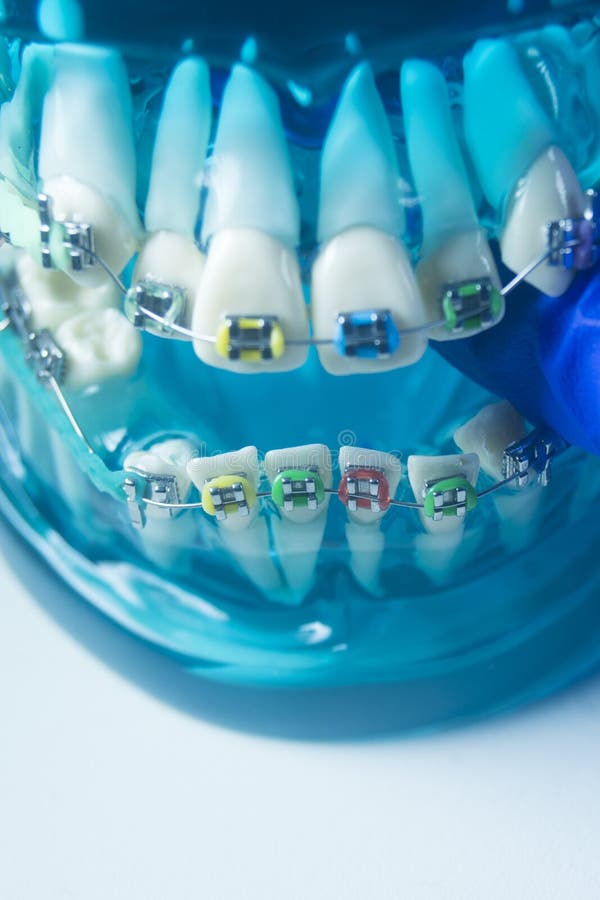 Metal teeth brackets stock image. Image of braces, clear 218045549
